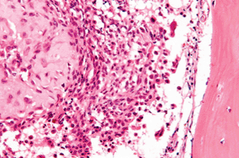 Image: Very high magnification micrograph of a chondroblastoma (H&E stain) (Photo courtesy of Wikimedia Commons).